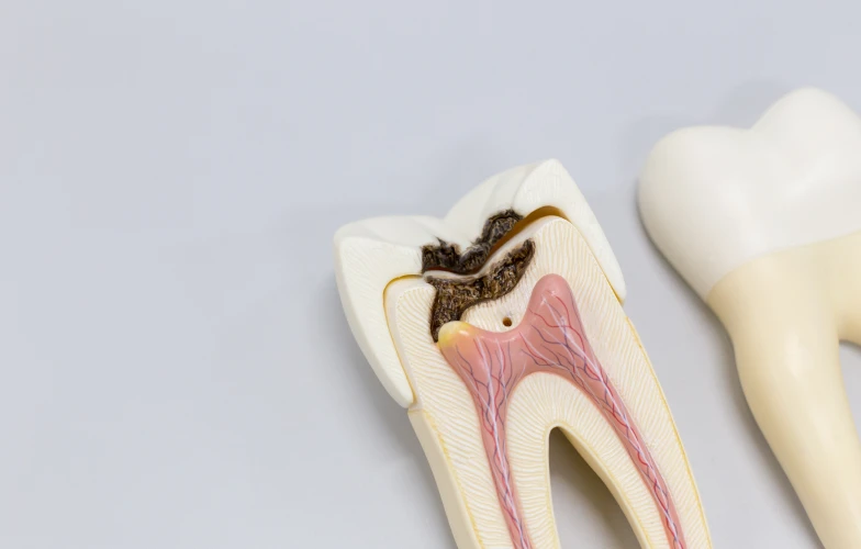 Traitement des Caries Sfax